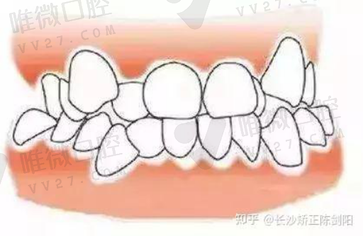 常规种植牙和即刻负重哪个好（即刻种植和即刻负重是一样的吗）(图1)
